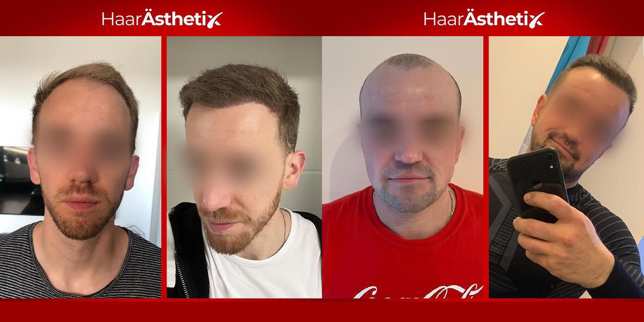 Haarausfallbehandlung für Stuttgart